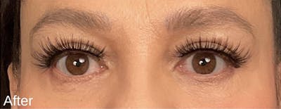 Blepharoplasty Before & After Gallery - Patient 292018 - Image 2