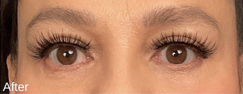 Blepharoplasty Before & After Gallery - Patient 292018 - Image 2