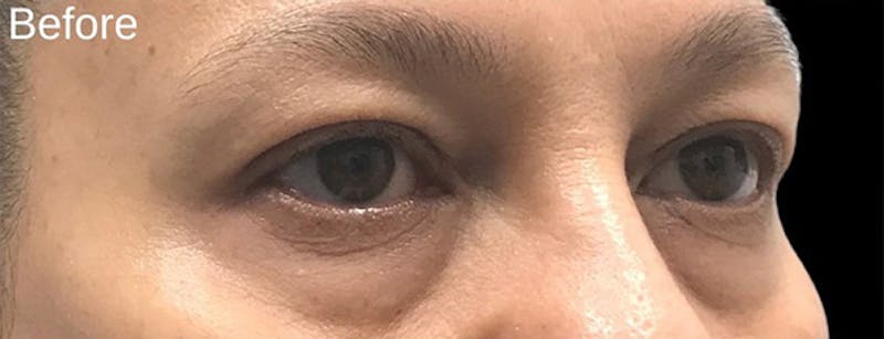 Blepharoplasty Before & After Gallery - Patient 292018 - Image 3