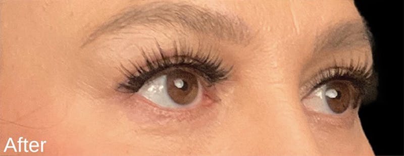 Blepharoplasty Before & After Gallery - Patient 292018 - Image 4