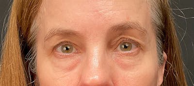 Brow Lift Before & After Gallery - Patient 217644 - Image 1