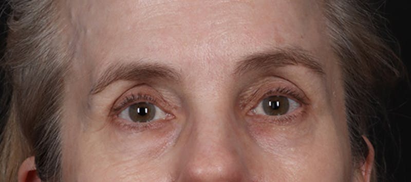 Brow Lift Before & After Gallery - Patient 217644 - Image 2