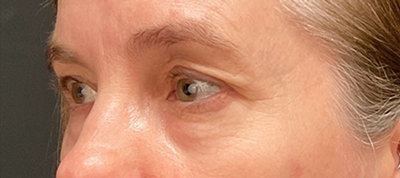 Brow Lift Before & After Gallery - Patient 217644 - Image 3