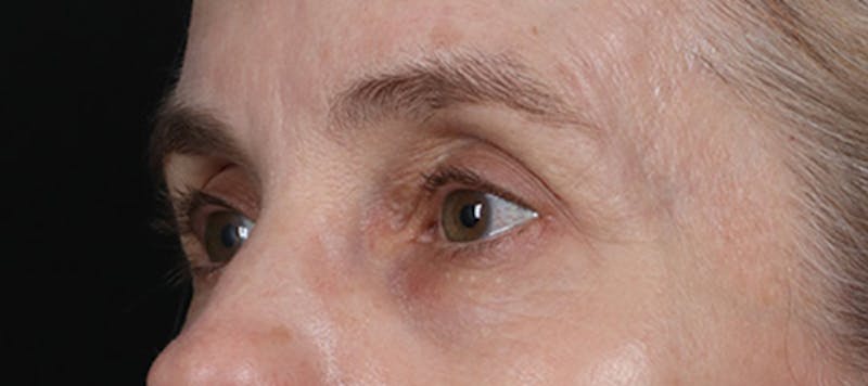 Brow Lift Before & After Gallery - Patient 217644 - Image 4