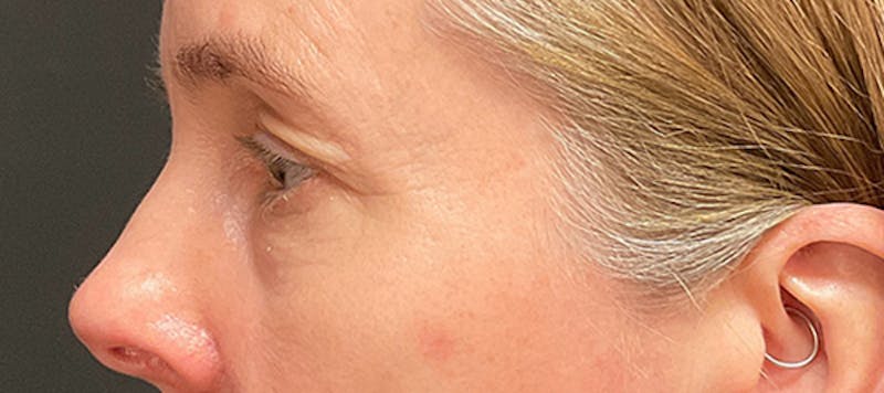 Brow Lift Before & After Gallery - Patient 217644 - Image 5
