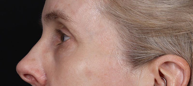 Brow Lift Before & After Gallery - Patient 217644 - Image 6