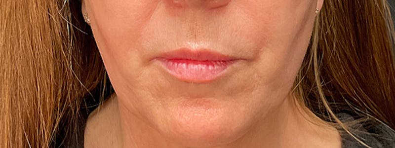 Lip Lift Before & After Gallery - Patient 353243 - Image 1