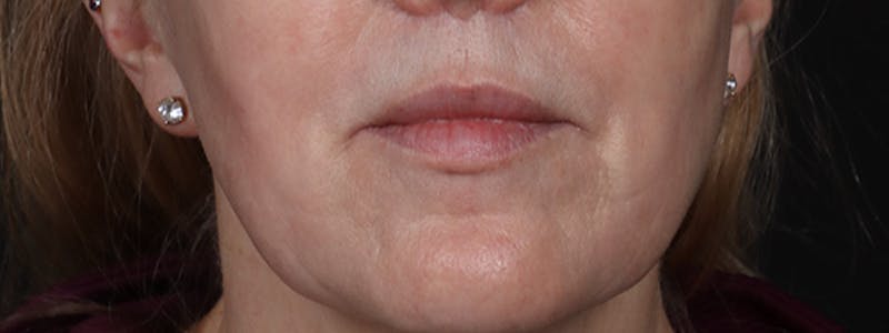 Lip Lift Before & After Gallery - Patient 353243 - Image 2