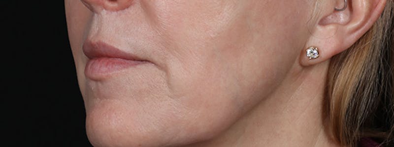 Lip Lift Before & After Gallery - Patient 353243 - Image 4