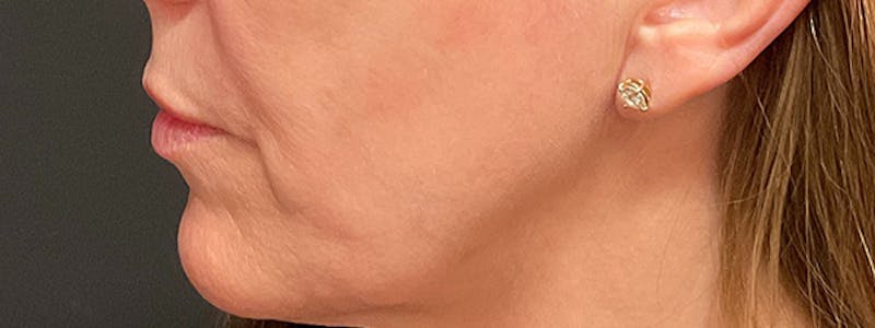 Lip Lift Before & After Gallery - Patient 353243 - Image 5