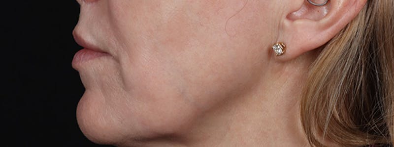 Lip Lift Before & After Gallery - Patient 353243 - Image 6