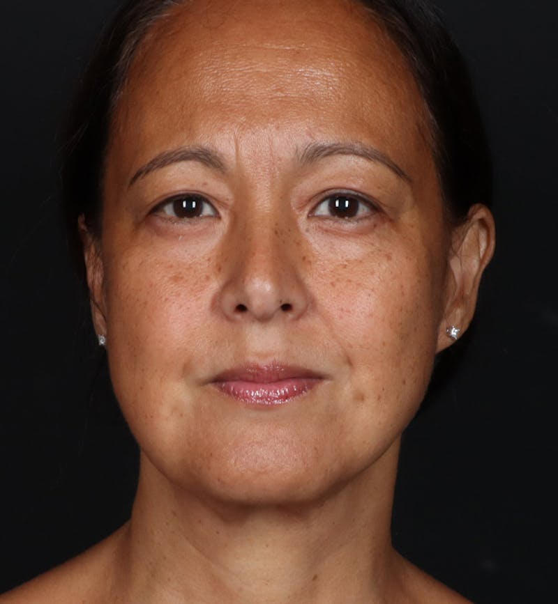 Deep Neck Lift Before & After Gallery - Patient 287232 - Image 4