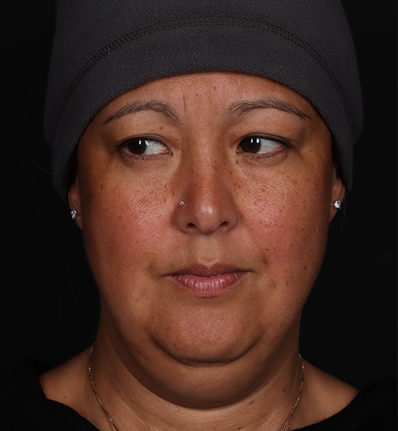 Deep Neck Lift Before & After Gallery - Patient 287232 - Image 3
