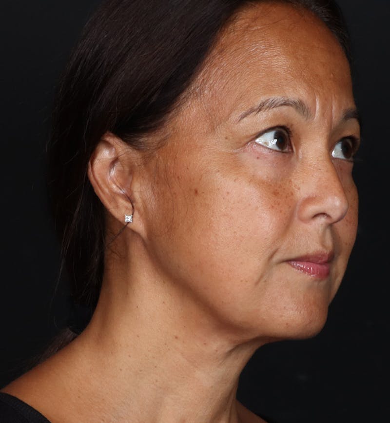 Deep Neck Lift Before & After Gallery - Patient 287232 - Image 2