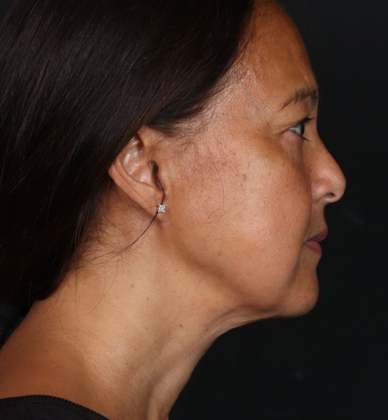 Deep Neck Lift Before & After Gallery - Patient 287232 - Image 6