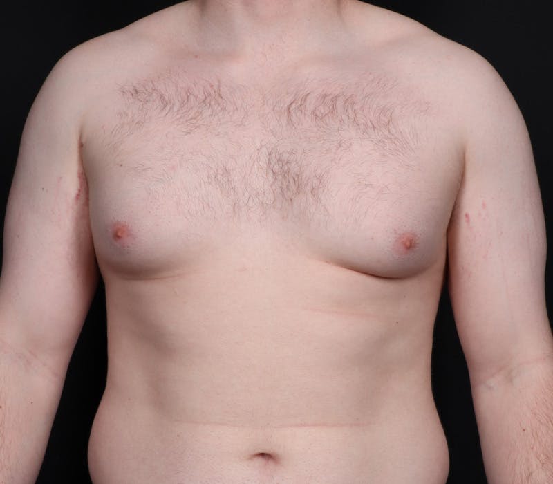 Gynecomastia Before & After Gallery - Patient 244885 - Image 1