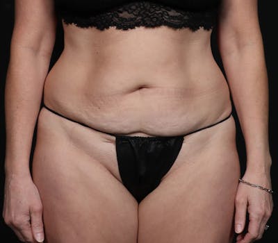 Liposuction Before & After Gallery - Patient 228308 - Image 1