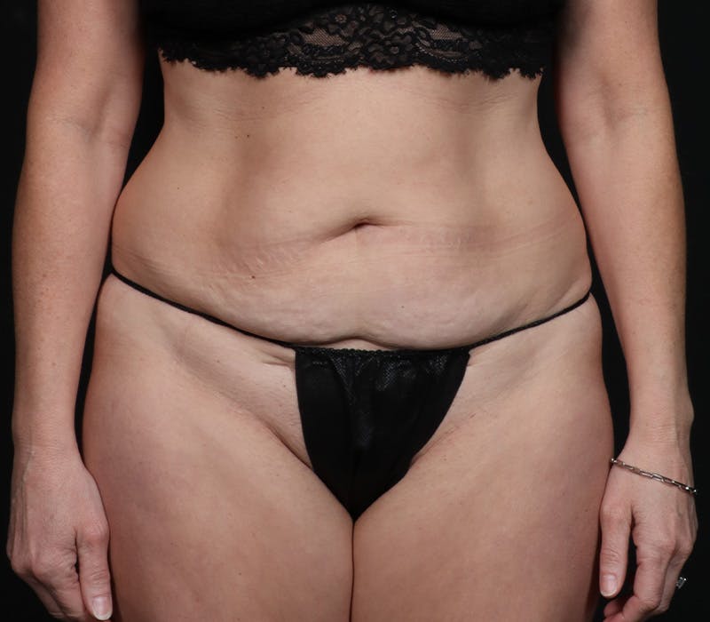 Abdominoplasty Before & After Gallery - Patient 203387 - Image 1