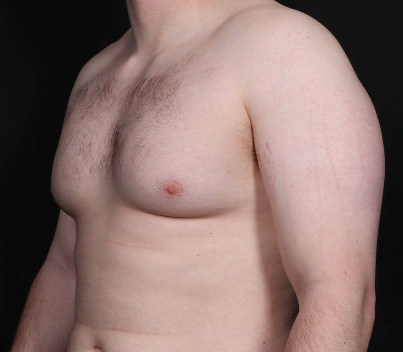 Gynecomastia Before & After Gallery - Patient 244885 - Image 3