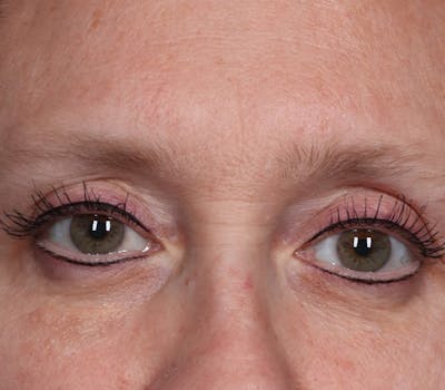 Blepharoplasty Before & After Gallery - Patient 336243 - Image 1