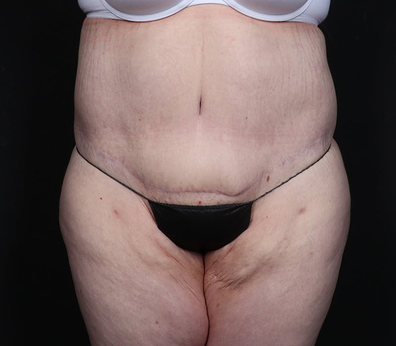 Abdominoplasty Before & After Gallery - Patient 216674 - Image 2