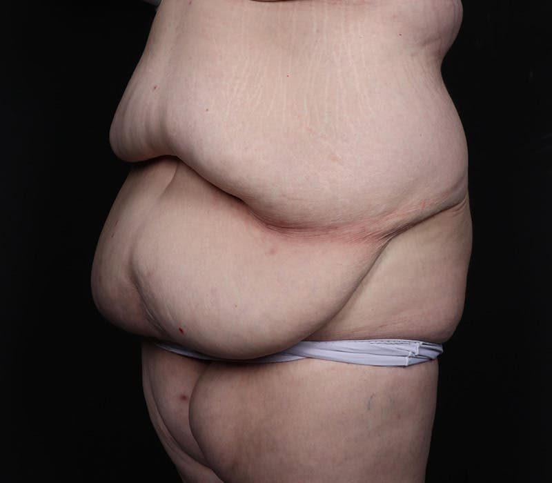 Abdominoplasty Before & After Gallery - Patient 216674 - Image 3