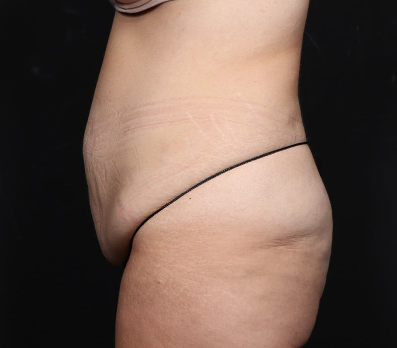 Abdominoplasty Before & After Gallery - Patient 429407 - Image 5