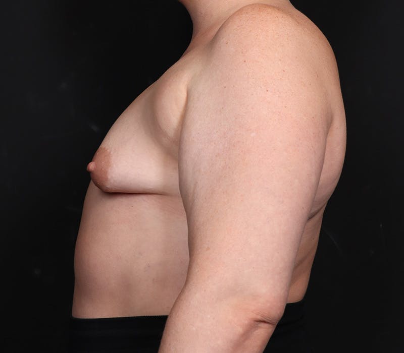 Breast Augmentation Before & After Gallery - Patient 428786 - Image 5