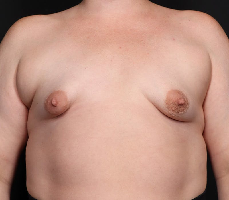 Breast Augmentation Before & After Gallery - Patient 428786 - Image 1