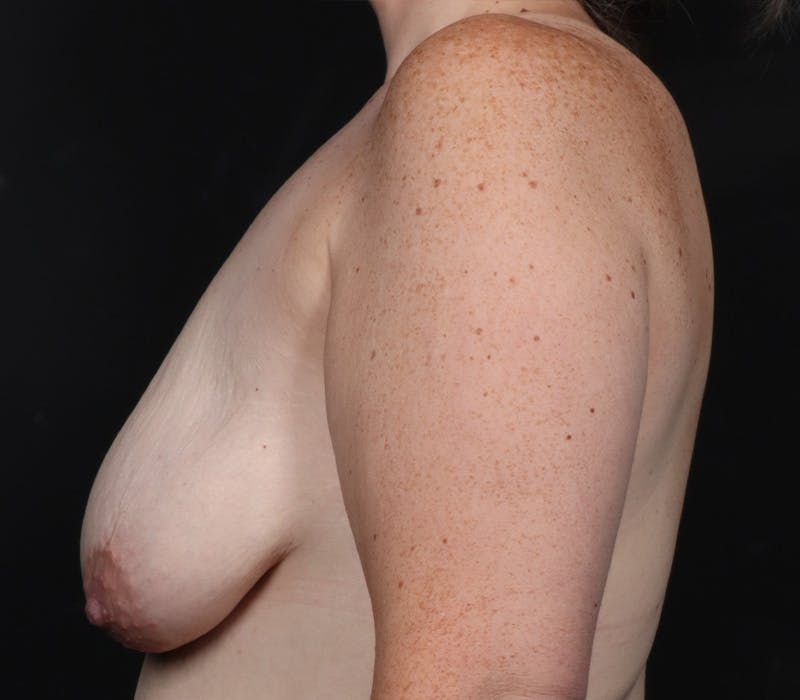 Mommy Makeover Before & After Gallery - Patient 358235 - Image 3