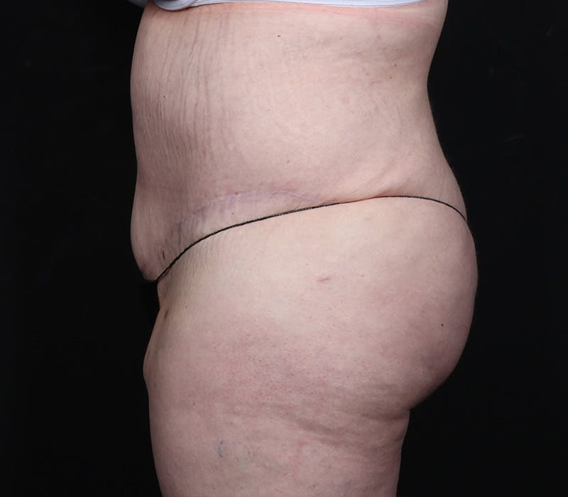 Abdominoplasty Before & After Gallery - Patient 216674 - Image 6
