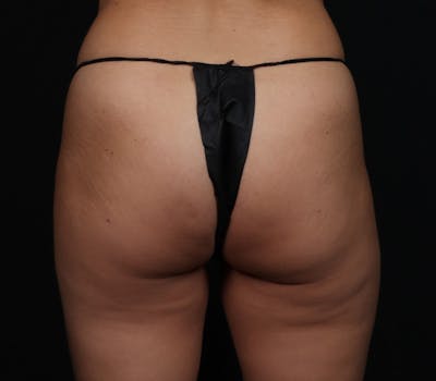 Brazilian Butt Lift Before & After Gallery - Patient 310559 - Image 1