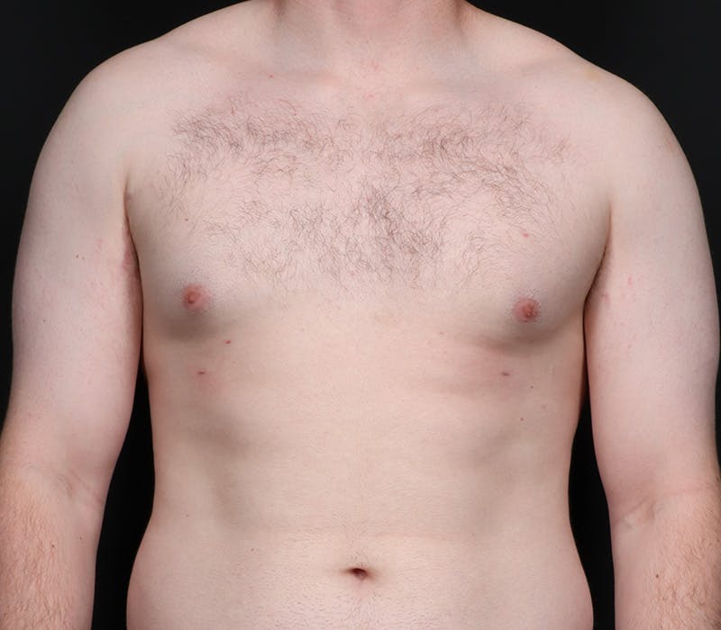 Gynecomastia Before & After Gallery - Patient 244885 - Image 2