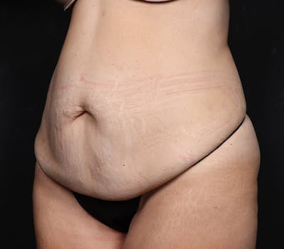 Abdominoplasty Before & After Gallery - Patient 429407 - Image 1