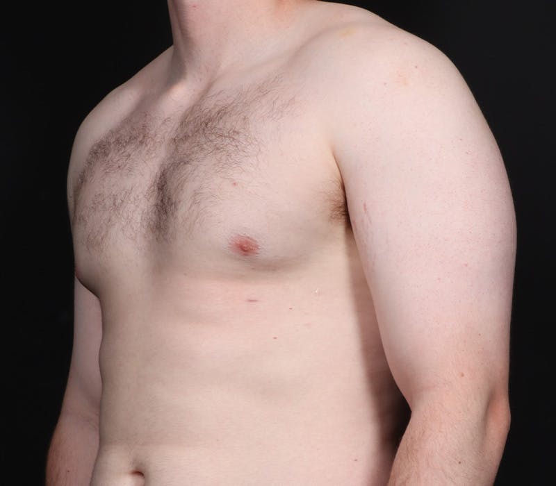 Gynecomastia Before & After Gallery - Patient 244885 - Image 4