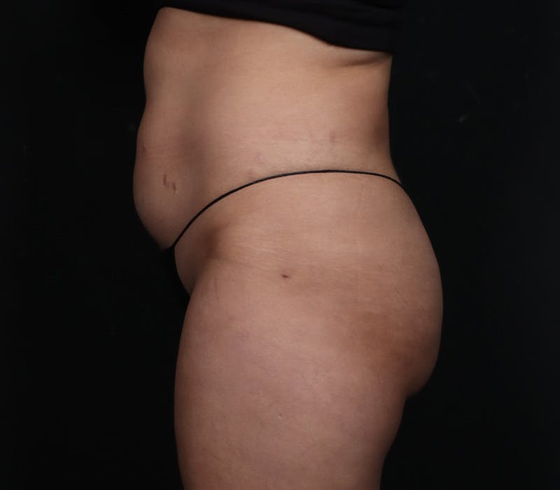 Liposuction Before & After Gallery - Patient 107873 - Image 6