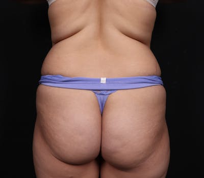Liposuction Before & After Gallery - Patient 107873 - Image 1