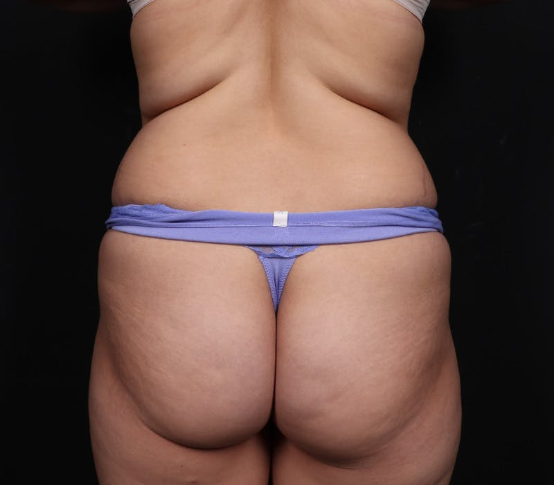 Liposuction Before & After Gallery - Patient 107873 - Image 1
