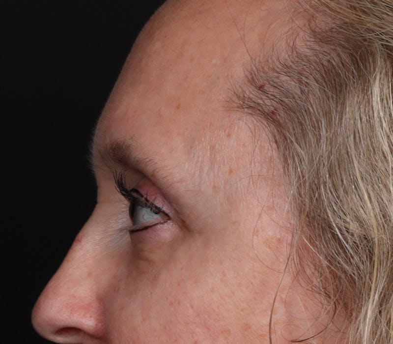 Blepharoplasty Before & After Gallery - Patient 336243 - Image 4