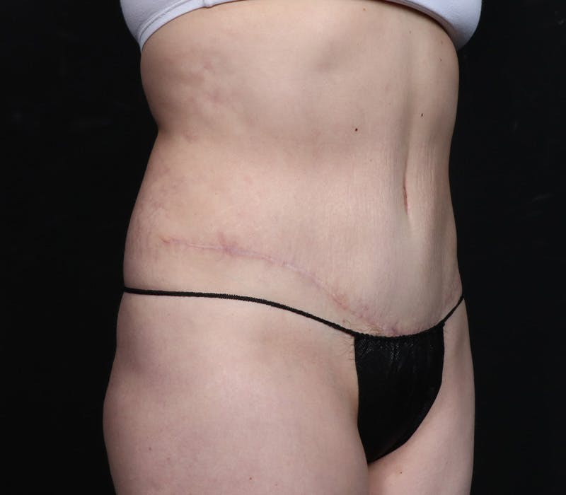 Abdominoplasty Before & After Gallery - Patient 247273 - Image 4