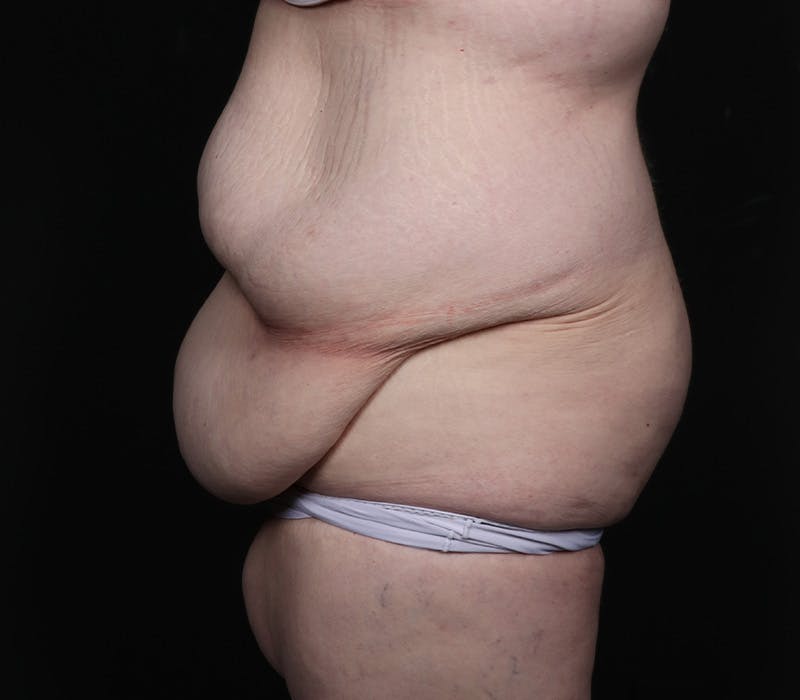 Abdominoplasty Before & After Gallery - Patient 216674 - Image 5