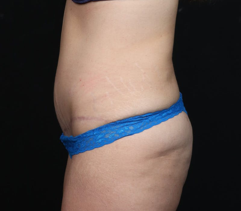 Abdominoplasty Before & After Gallery - Patient 429407 - Image 6