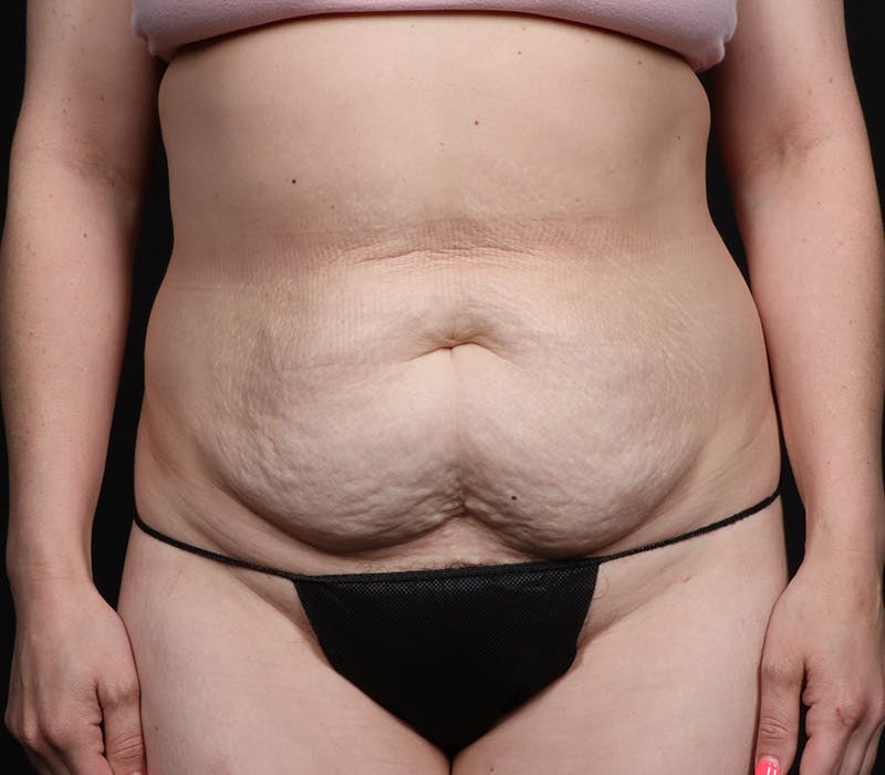 Abdominoplasty Before & After Gallery - Patient 247273 - Image 5