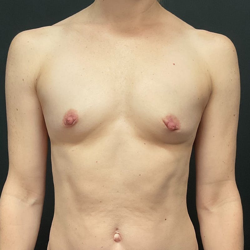 Breast Augmentation Before & After Gallery - Patient 151547 - Image 5