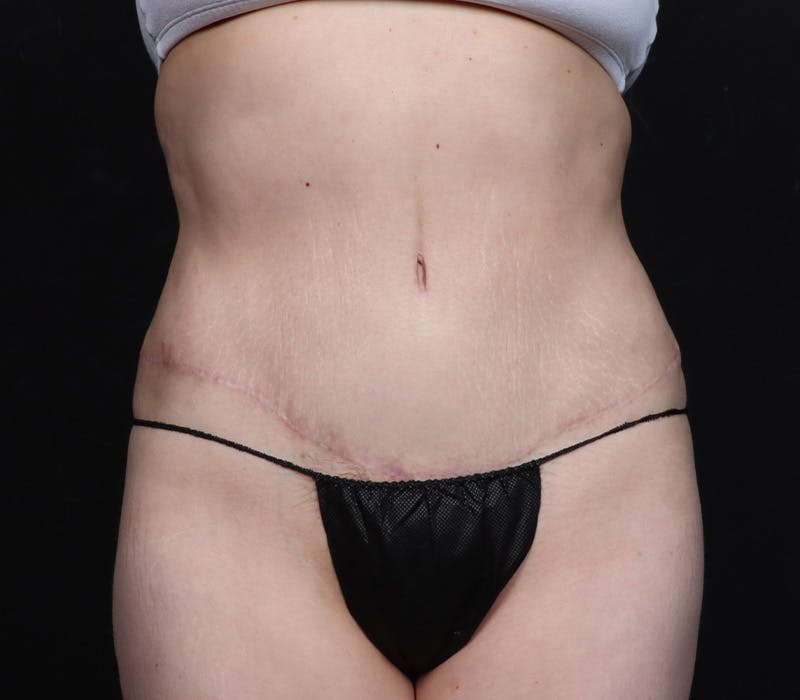 Abdominoplasty Before & After Gallery - Patient 247273 - Image 6