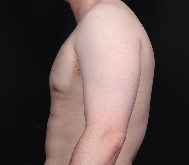 Gynecomastia Before & After Gallery - Patient 244885 - Image 6