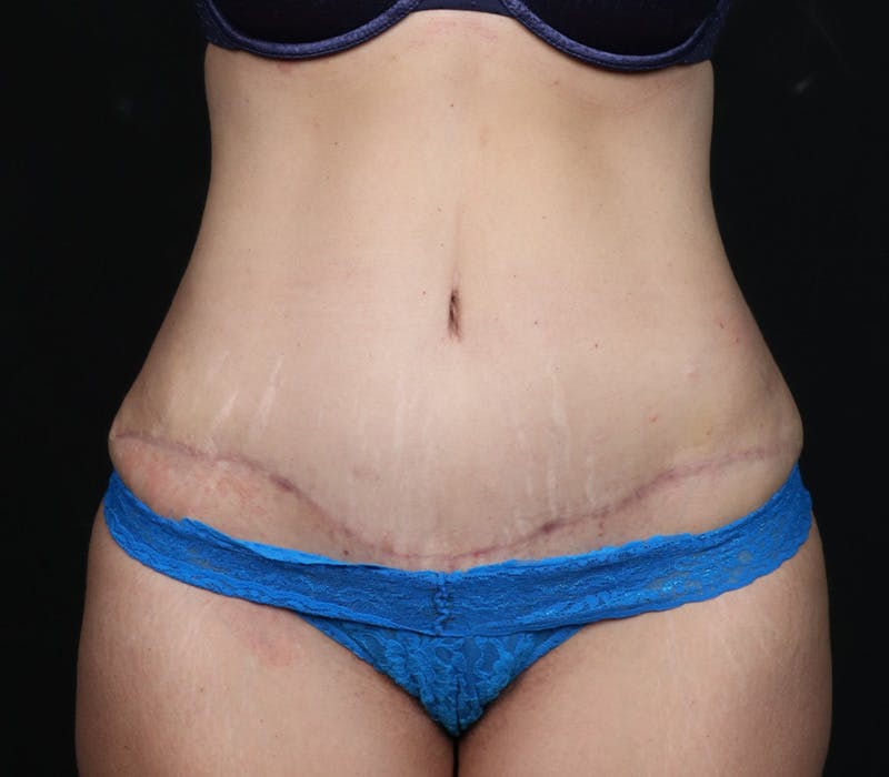 Abdominoplasty Before & After Gallery - Patient 429407 - Image 4