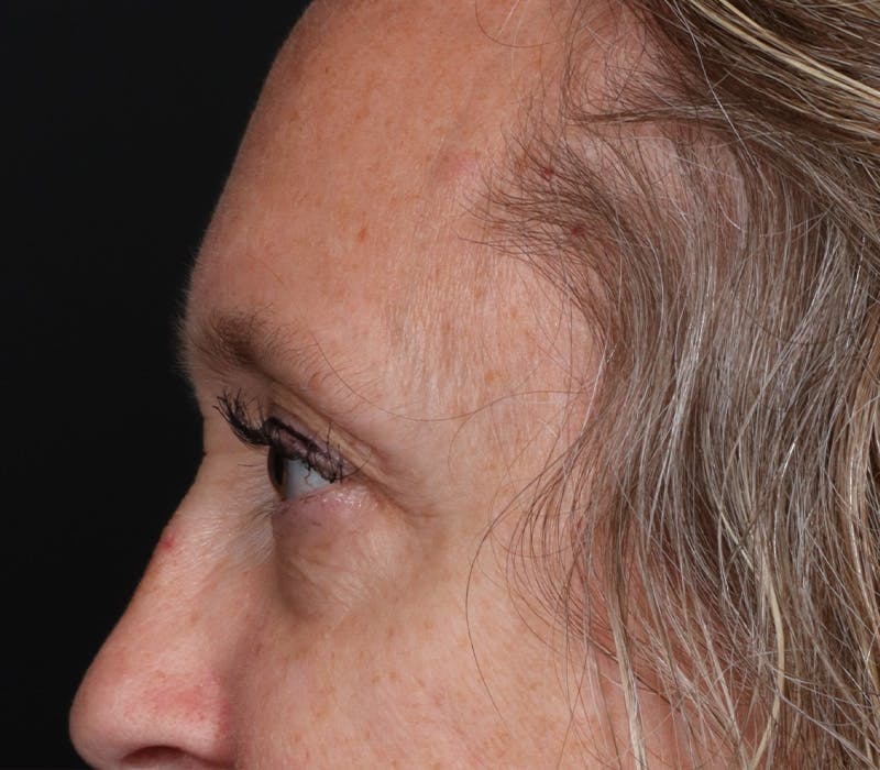 Blepharoplasty Before & After Gallery - Patient 336243 - Image 3