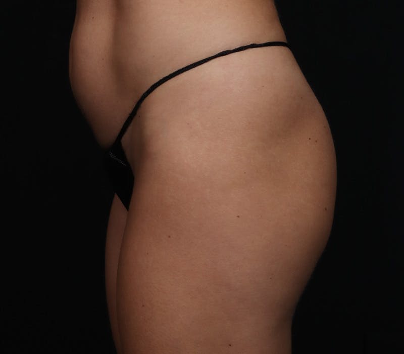 Brazilian Butt Lift Before & After Gallery - Patient 310559 - Image 5