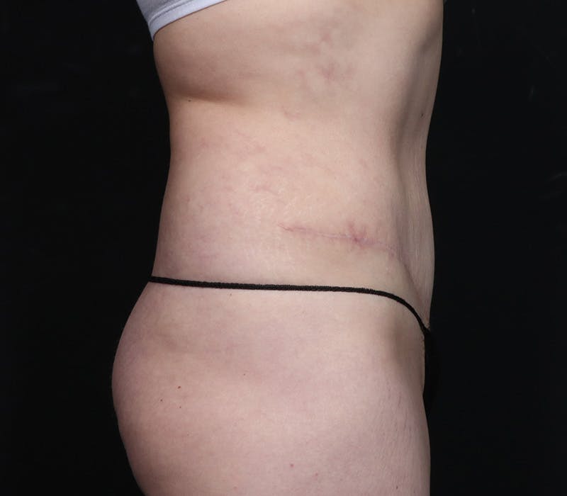 Abdominoplasty Before & After Gallery - Patient 247273 - Image 2